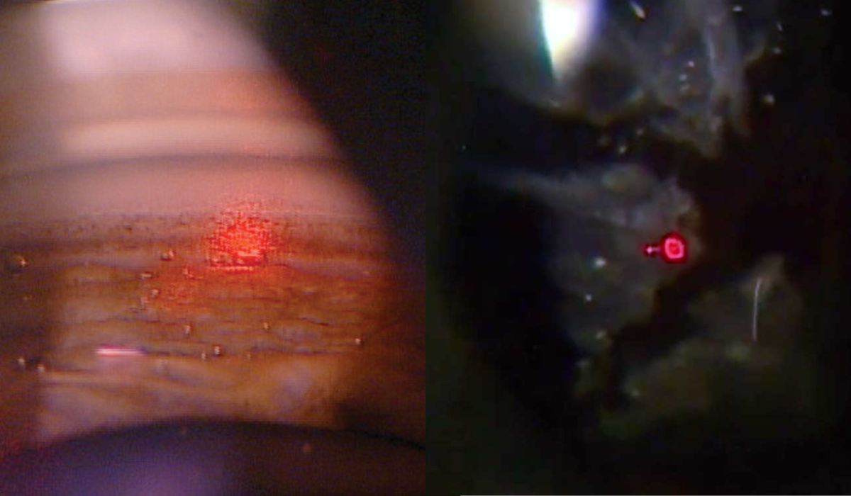 Alabama's laser bill would allow optometrists to perform SLT (left) and YAG capsulotomy (right), as well as remove lid lesions.
